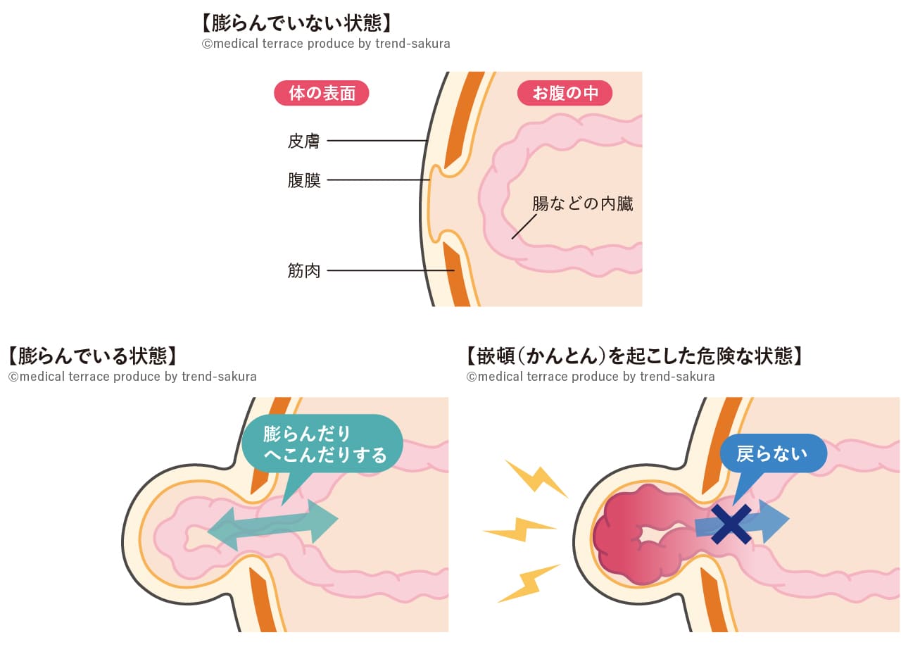 ヘルニア 出やすい症状
