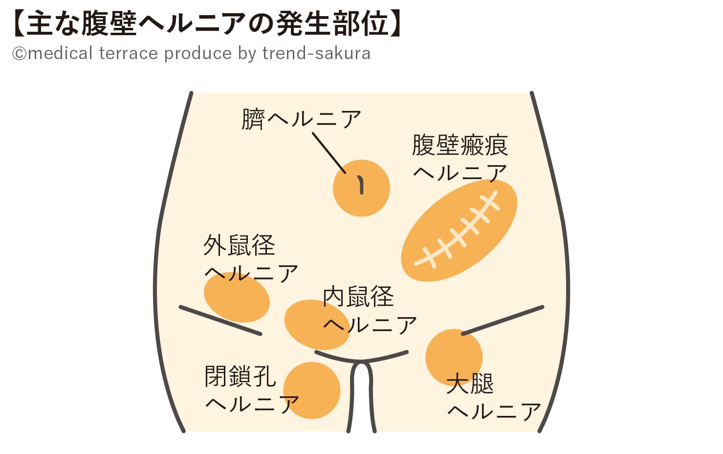 主な腹壁ヘルニアの発生部位