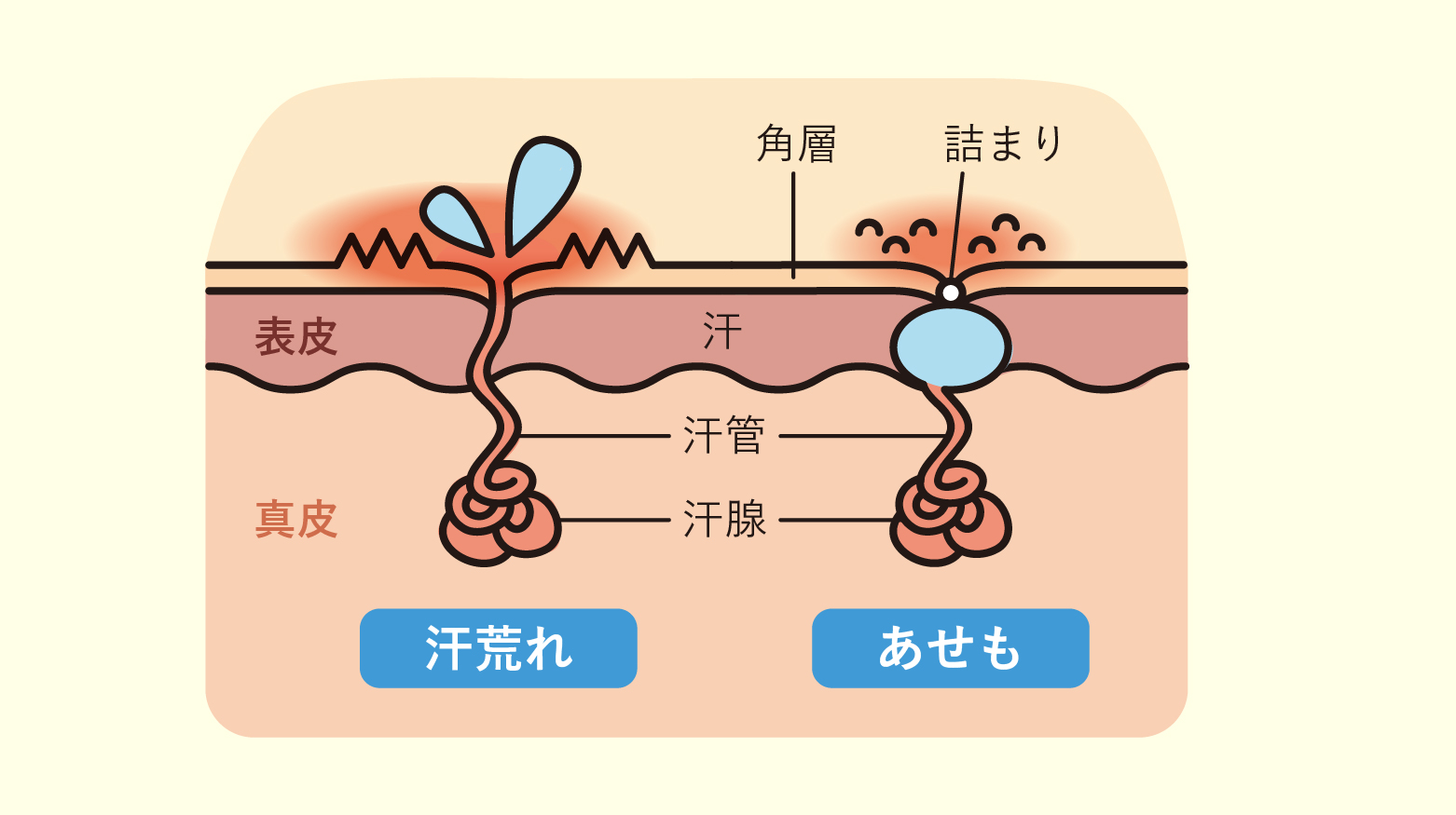 汗荒れ