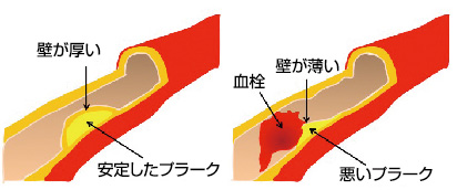 プラークにより狭窄した血管