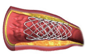 ステントを留置した血管