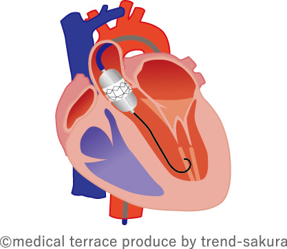 経カテーテル大動脈弁置換術（TAVI）